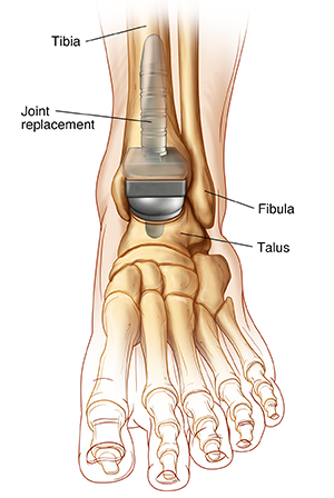 Front view of ankle and foot bones, showing ankle joint replacement.