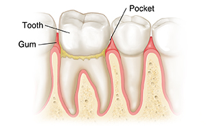 Teeth in gums showing gingivitis.