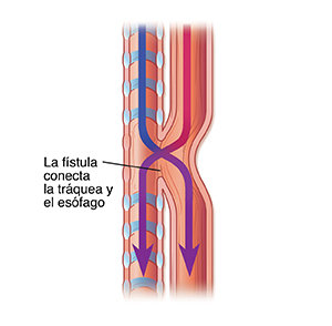 Vista lateral de una tráquea y un esófago con una fístula traqueoesofágica.