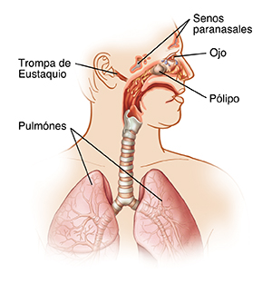 Contorno de la cabeza y el pecho de un hombre con la cabeza girada hacia un lado, donde se ven senos paranasales inflamados, pólipos nasales, goteo posnasal y ojos rojos.