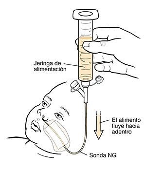 Mano sosteniendo una jeringa llena de alimento líquido conectada a una sonda nasogástrica de un niño pequeño. El alimento fluye desde la jeringa hasta la sonda.