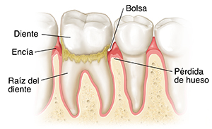 Dientes en encías que muestran periodontitis.