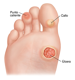 Planta del pie que presenta callos, punto caliente y úlcera.